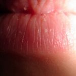 250px-dry-lips-4784